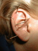 (Abb. 16) Akupunkturnadeln im rechten Ohr